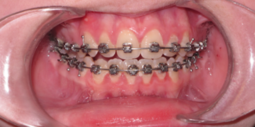 Image of Teeth with Good Oral Hygiene