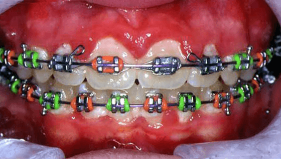 Teeth with bad oral hygiene