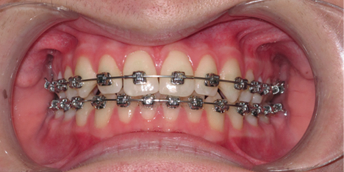 Image of Teeth with Excellent Oral Hygiene