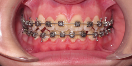 Image of Teeth with Oral Hygiene Needing Improvement