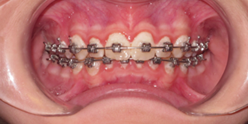 Image of Teeth with Poor Oral Hygiene