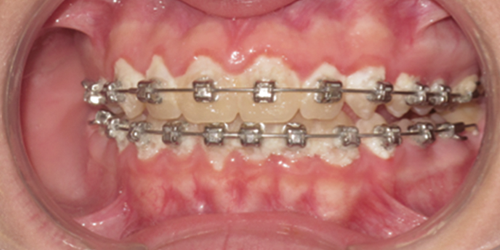 Image of Teeth with Very Poor Oral Hygiene